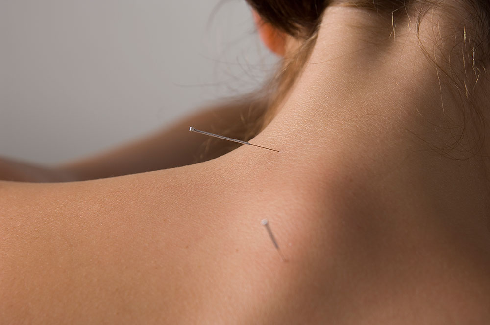 Acupuncture